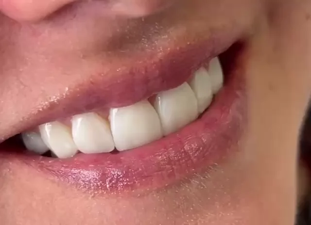 Primer plano de una sonrisa con los dientes alineados y de color natural